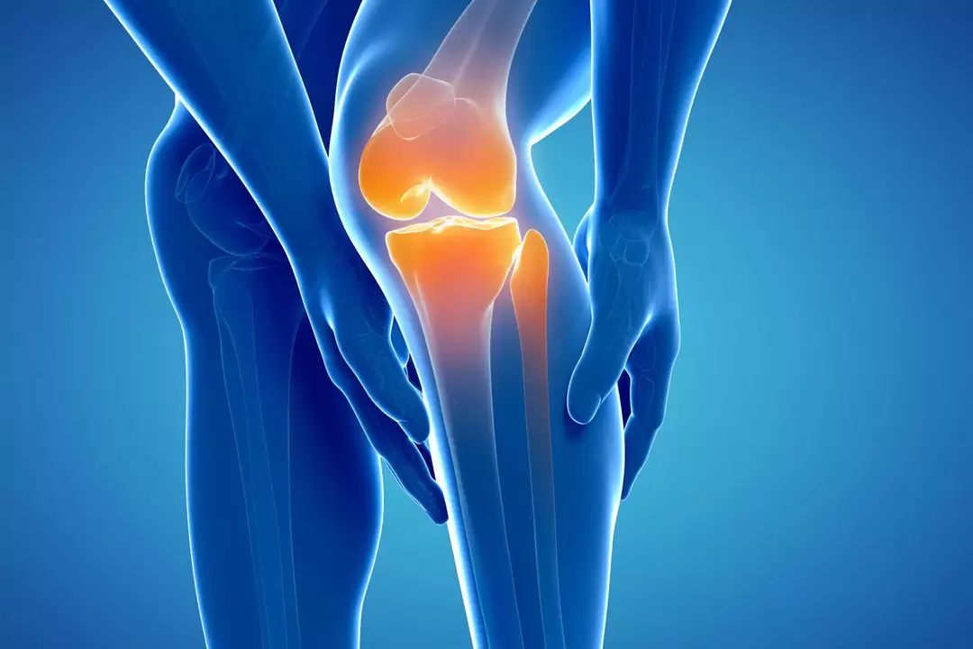 Arthrosis of the knee joint (gonarthrosis, deforming arthrosis)