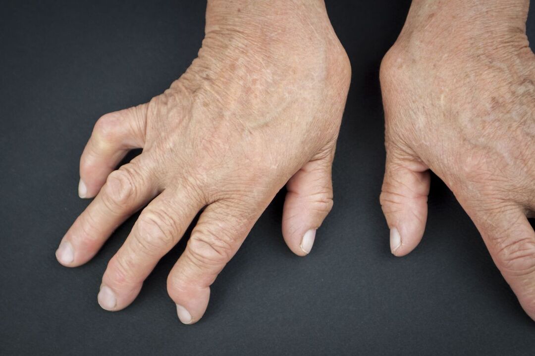 Gout of the hands