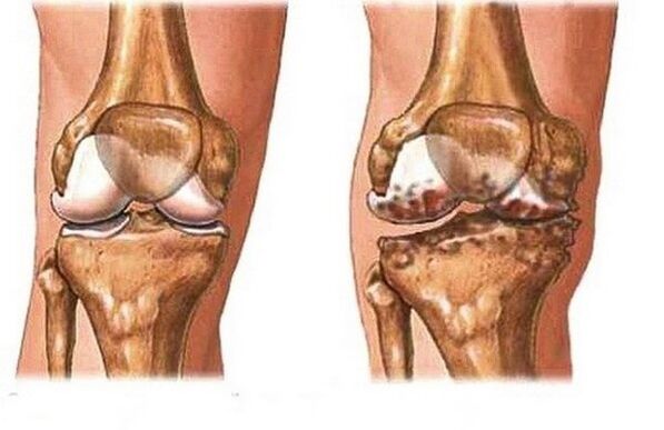 Healthy and aching joint