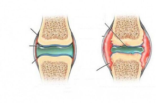 The process of deforming the joint
