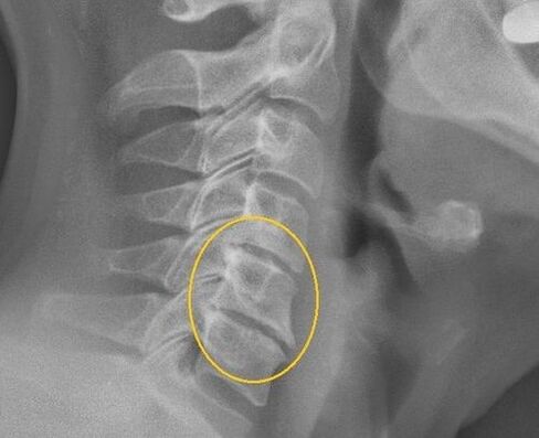 Osteochondrosis of the cervical spine on an X rays
