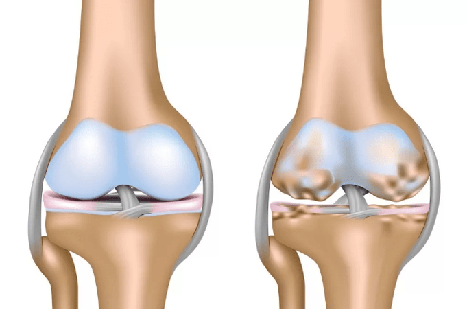Deformation of the arthrosis of the knee joint