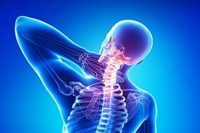 Neck pain due to osteochondrosis