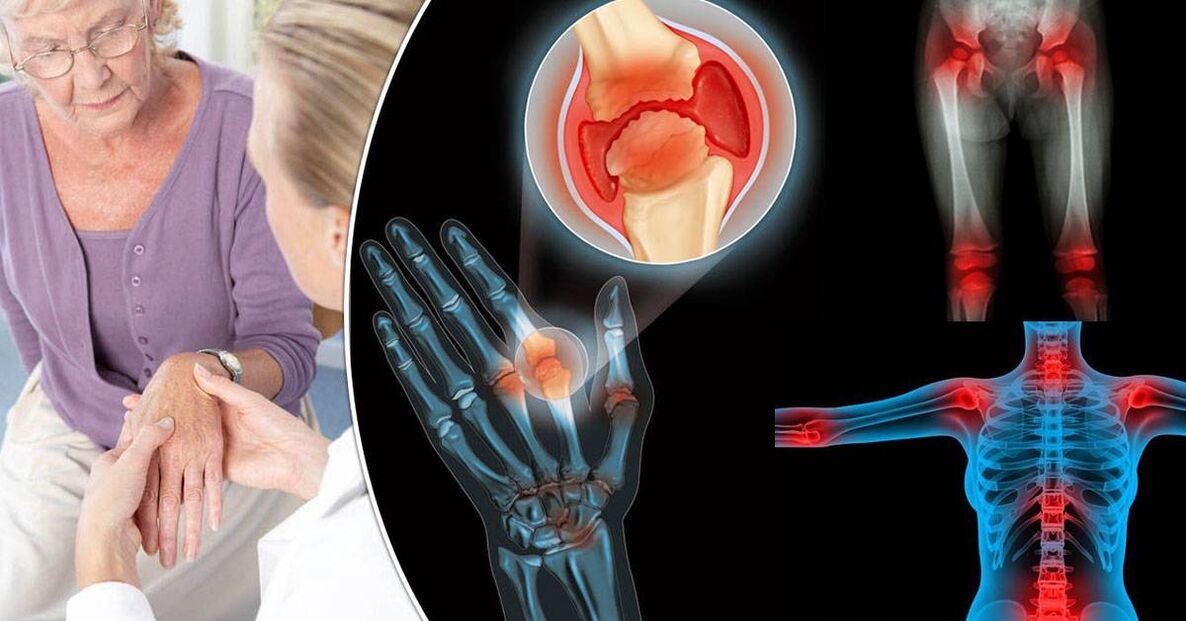 What is osteoarthritis